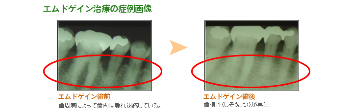 エムドゲイン治療