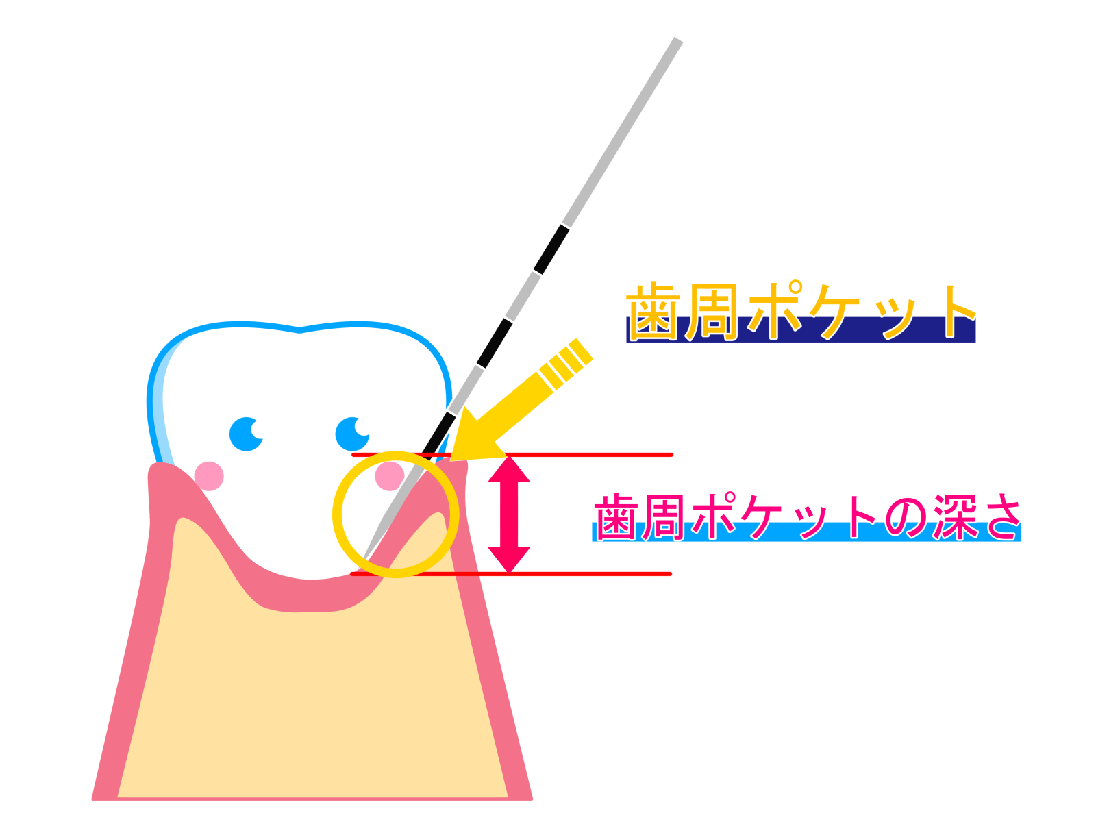 歯医者での歯周病検査とは