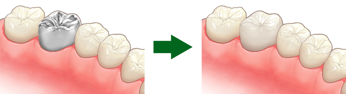 自由診療のセラミック治療