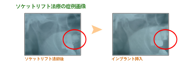 ソケットリフト法療の症例